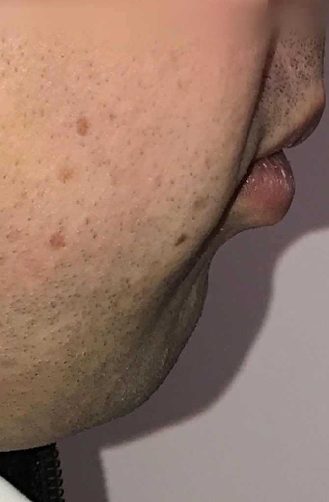 Chin Advancement — before (pre-operative)